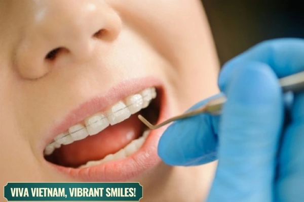Ceramic Braces – An Effective and Aesthetic Orthodontic Solution