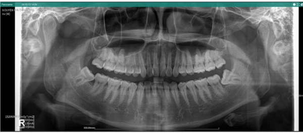 Delaying wisdom tooth extraction for 4 years: Unforeseeable consequences and lessons learned from a clinical case