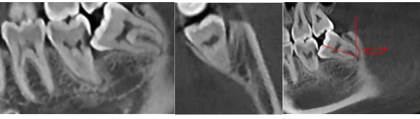 Delaying wisdom tooth extraction for 4 years: Unforeseeable consequences and lessons learned from a clinical case
