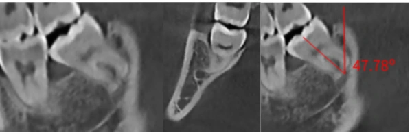 Delaying wisdom tooth extraction for 4 years: Unforeseeable consequences and lessons learned from a clinical case