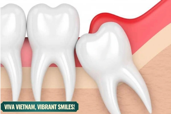 Delaying wisdom tooth extraction for 4 years: Unforeseeable consequences and lessons learned from a clinical case