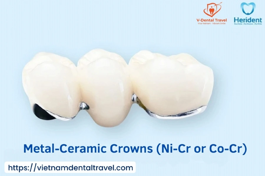 Aesthetic Porcelain Crowns – Brighten Your Smile with Natural-Looking Dental Restorations