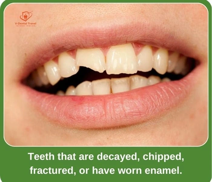Aesthetic Porcelain Crowns – Brighten Your Smile with Natural-Looking Dental Restorations