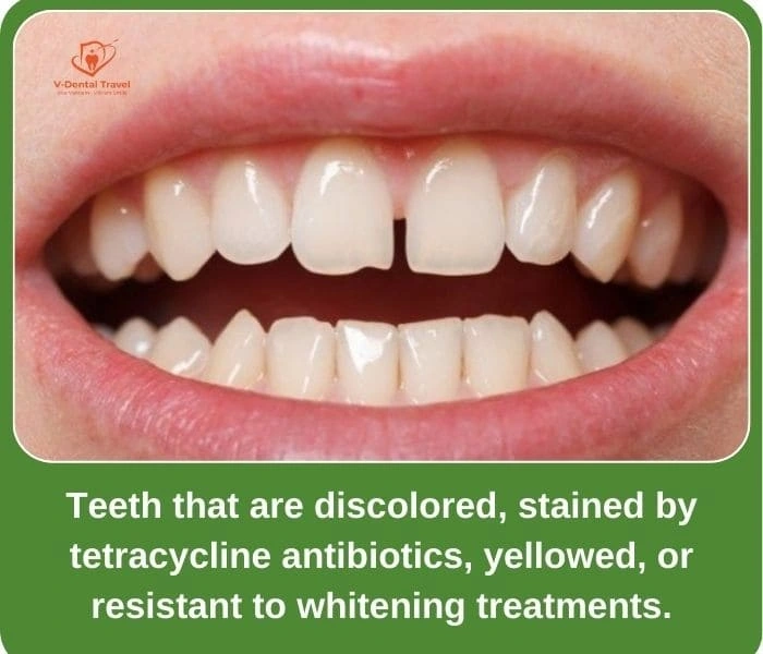 Aesthetic Porcelain Crowns – Brighten Your Smile with Natural-Looking Dental Restorations