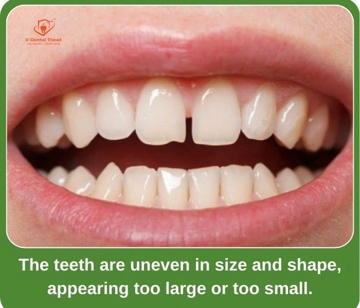 Aesthetic Porcelain Crowns – Brighten Your Smile with Natural-Looking Dental Restorations