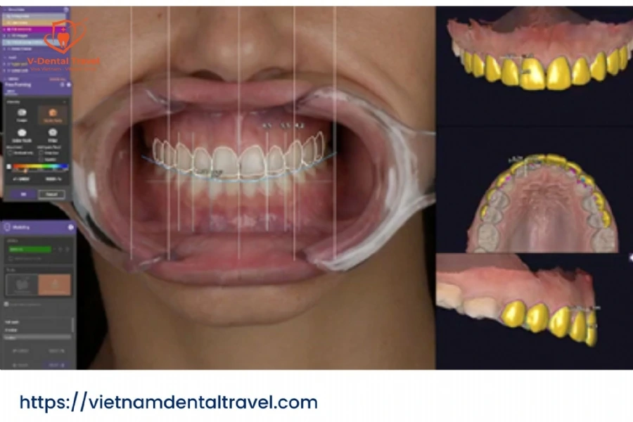 Aesthetic Porcelain Crowns – Brighten Your Smile with Natural-Looking Dental Restorations