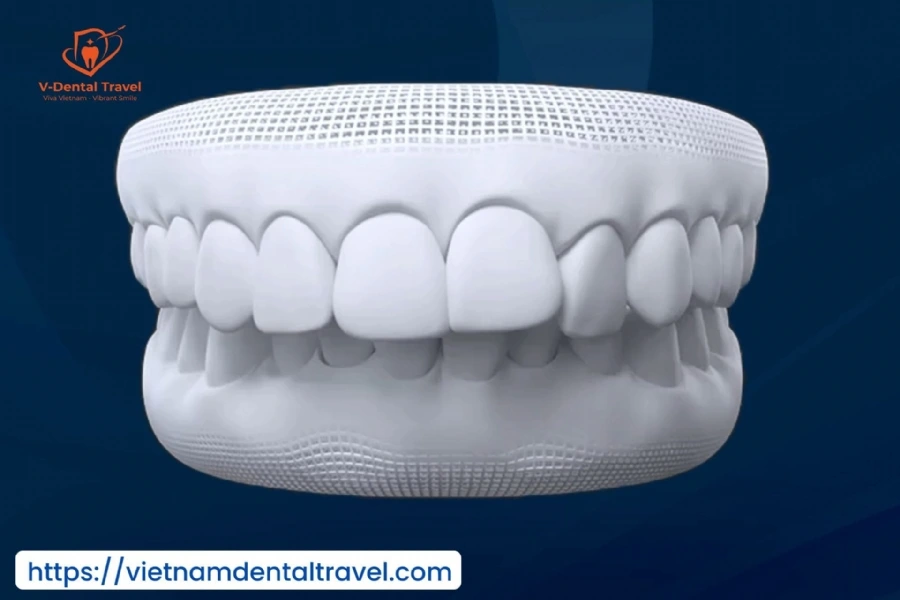 Orthodontic Treatment at Vietnam Dental Travel – Modern Braces for a Confident Smile