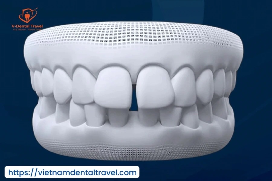 Orthodontic Treatment at Vietnam Dental Travel – Modern Braces for a Confident Smile