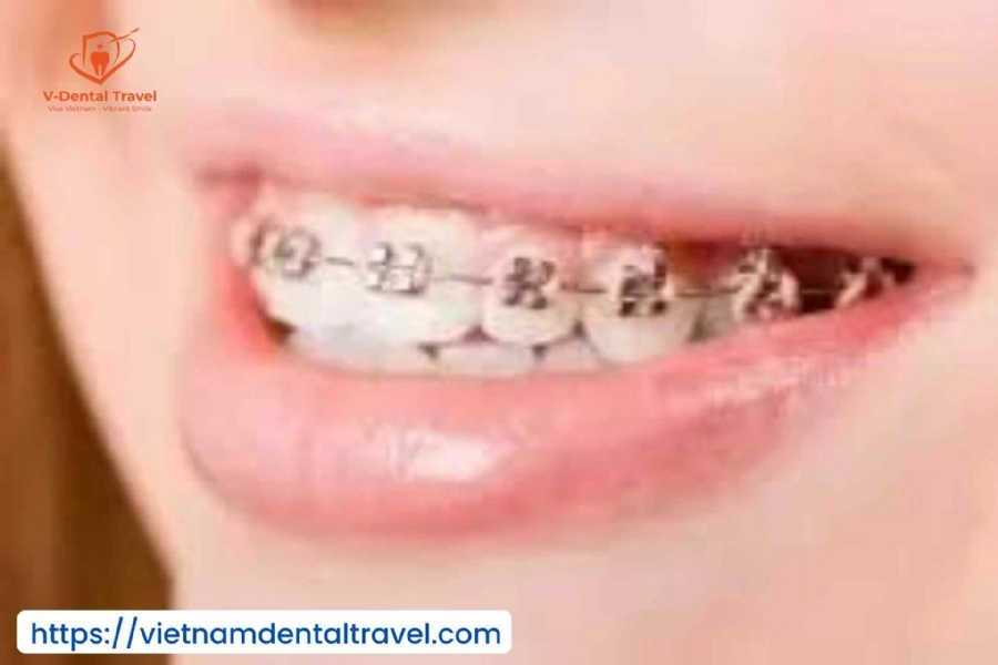 Orthodontic Treatment at Vietnam Dental Travel – Modern Braces for a Confident Smile