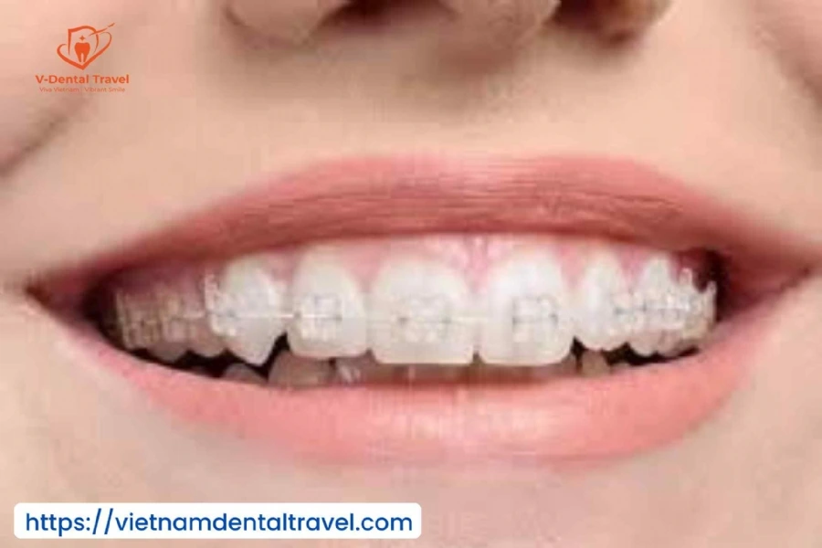 Orthodontic Treatment at Vietnam Dental Travel – Modern Braces for a Confident Smile
