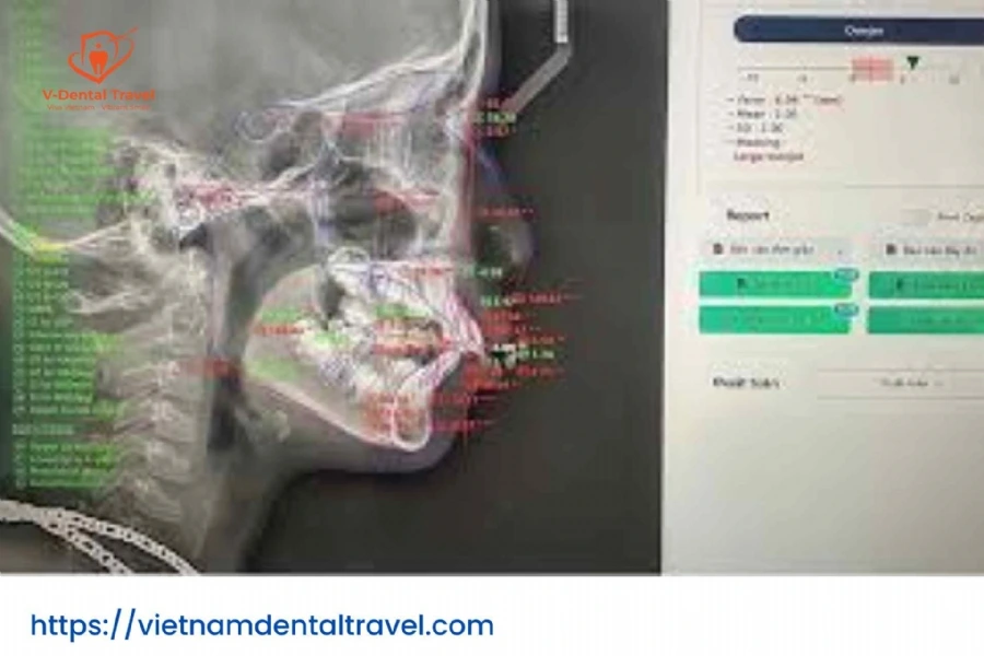 Orthodontic Treatment at Vietnam Dental Travel – Modern Braces for a Confident Smile