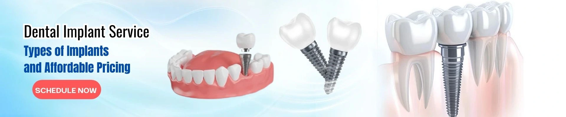 Dental Implant Service