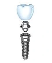 Dental Implant Service