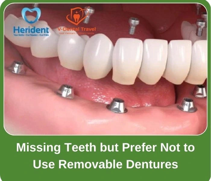 Dental Implant Service