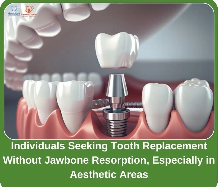 Dental Implant Service