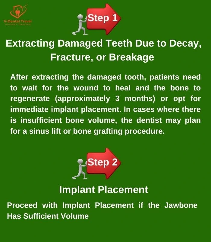 Dental Implant Service