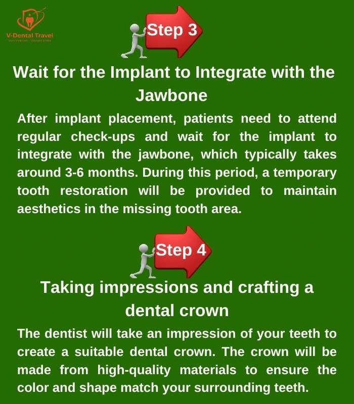 Dental Implant Service