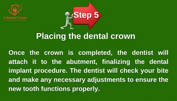 Dental Implant Service
