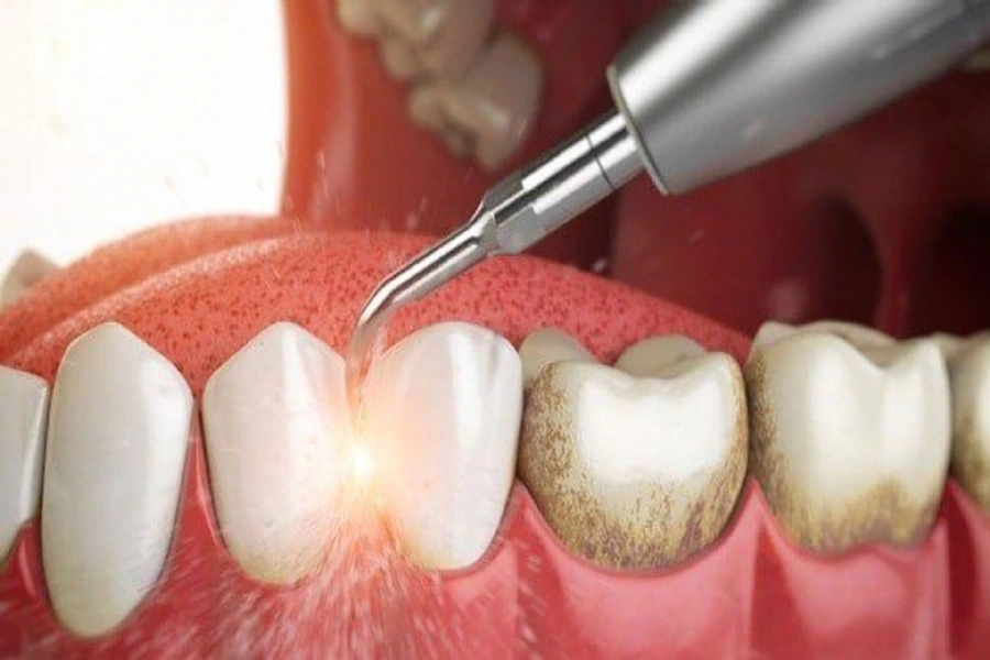 Understanding Periodontology – Causes, Risks, and Treatments for Gum Disease