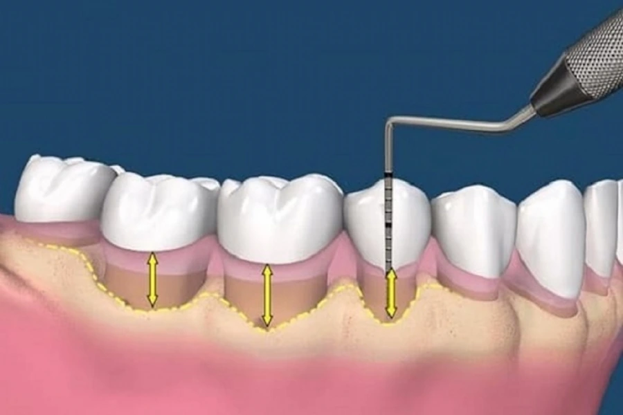 Understanding Periodontology – Causes, Risks, and Treatments for Gum Disease