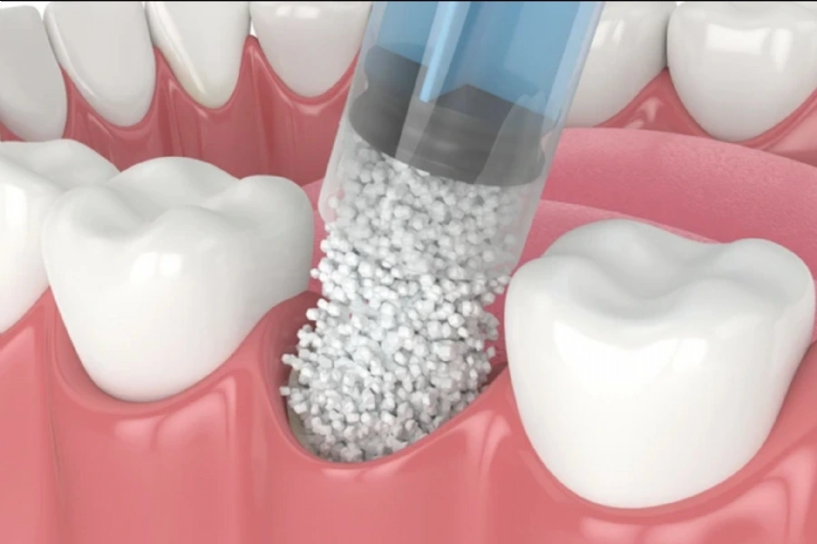 Understanding Periodontology – Causes, Risks, and Treatments for Gum Disease