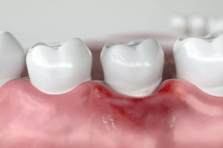 Understanding Periodontology – Causes, Risks, and Treatments for Gum Disease