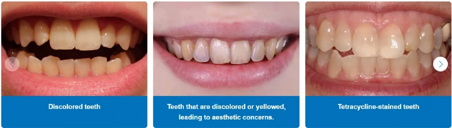 What is Teeth Whitening