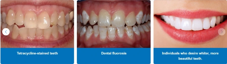 What is Teeth Whitening