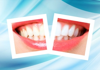 Professional Teeth Whitening in Vietnam | Vietnam Dental Travel