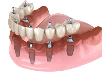 Multiple Dental Implants At Vietnam Dental Travel – All-on-4 & All-on-6 Solutions at Affordable Prices