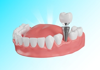 Single Tooth Implant At Vietnam Dental Travel – Safe, Aesthetic, and Long-lasting Solution